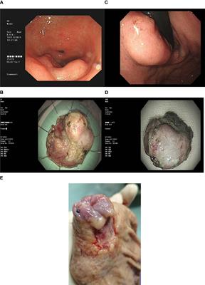Case Report: Clinicopathological characteristics of patients with gastric cancer with features of a submucosal tumour